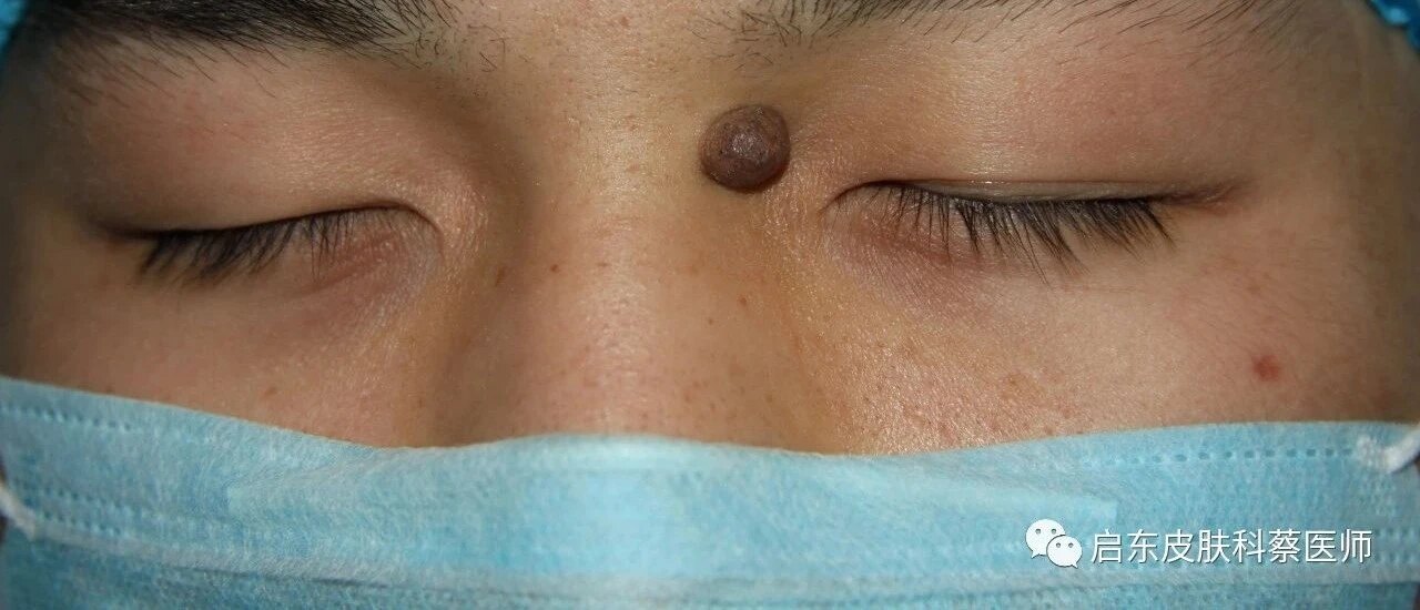 ⑶ 皮内痣:成人常见,可发生于任何部位,常见于头颈部,呈半球形的丘疹