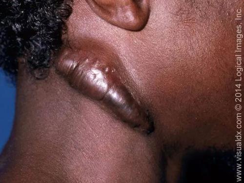 疤痕,增生性瘢痕,瘢痕疙瘩的不同_疤痕_疤痕症状表现 - 好大夫在线