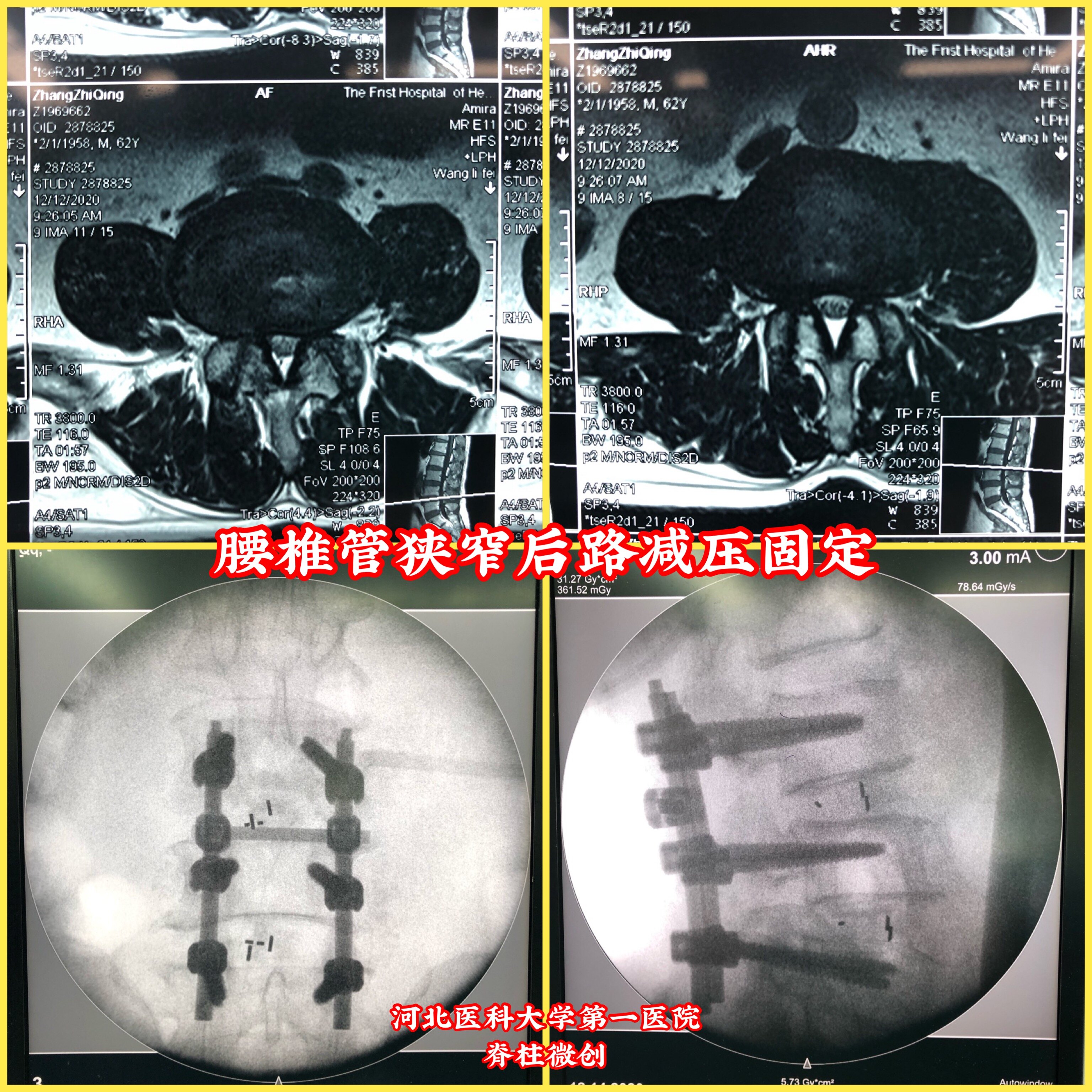 腰椎管狭窄后路减压固定融合 