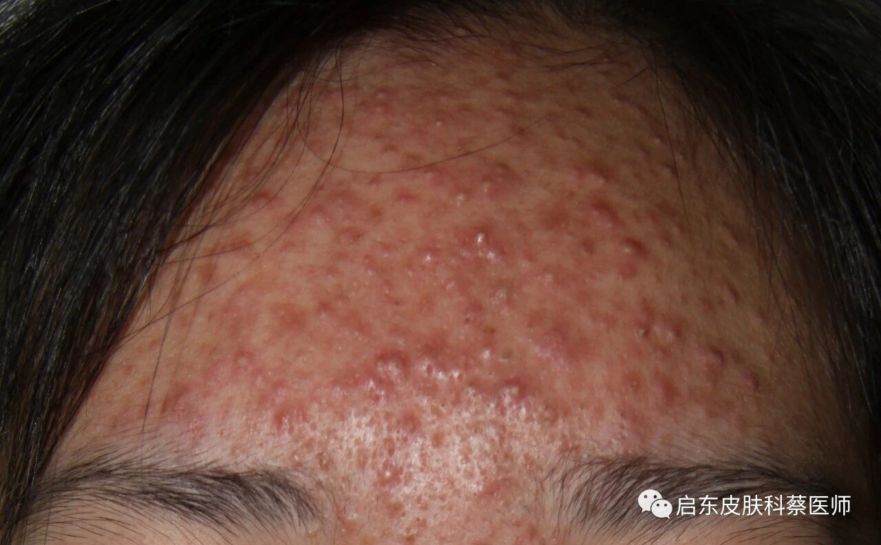 无锡二院看青春痘_无锡看青春痘_无锡治疗青春痘哪家医院好