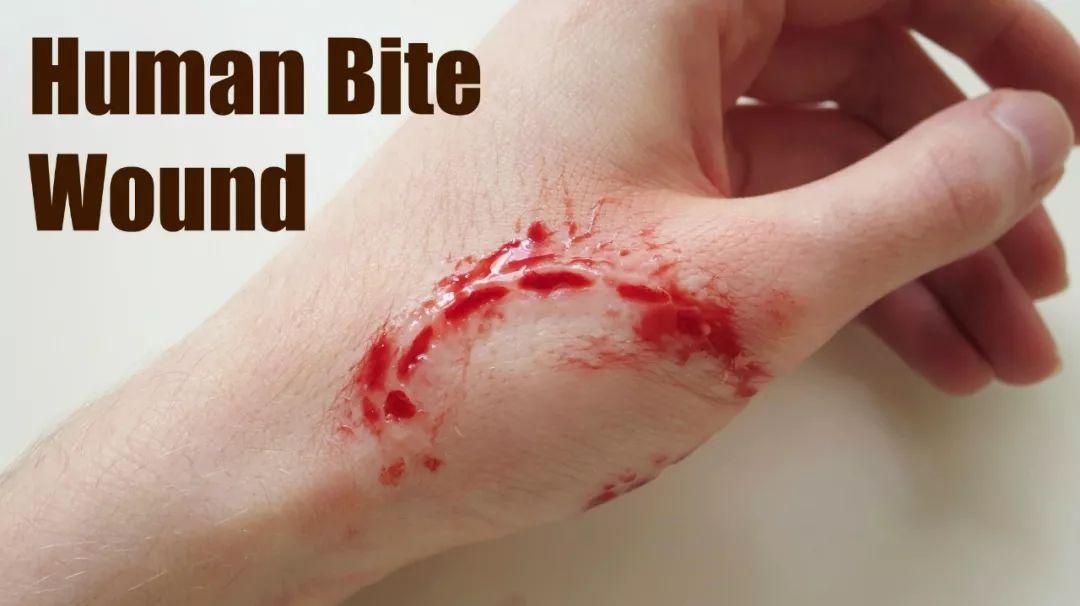 因此,人咬伤较其他外伤更易于出现坏死性软组织感染.