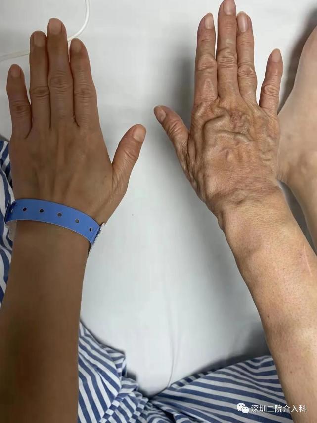 右手治疗前后对比:略有肿胀为术后轻度炎症水肿,原曲张静脉基本消退.