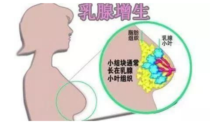 婦女常見的惡性腫瘤之乳腺癌隱性乳腺癌的發病與何有關