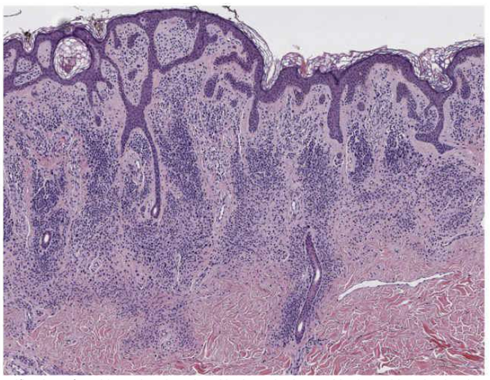 先天性黑色素细胞痣的组织学(显微镜下的样子) - 好大夫在线