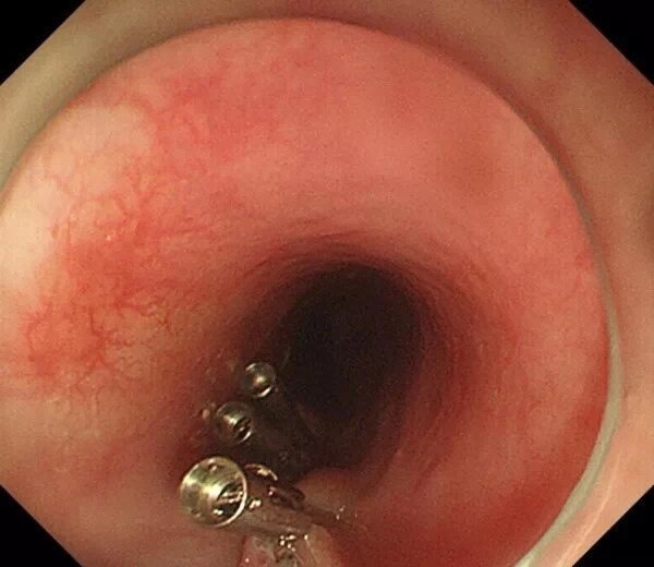 术(efr),内镜黏膜下挖除术(ese),内镜经黏膜下隧道肿瘤切除术(ster)