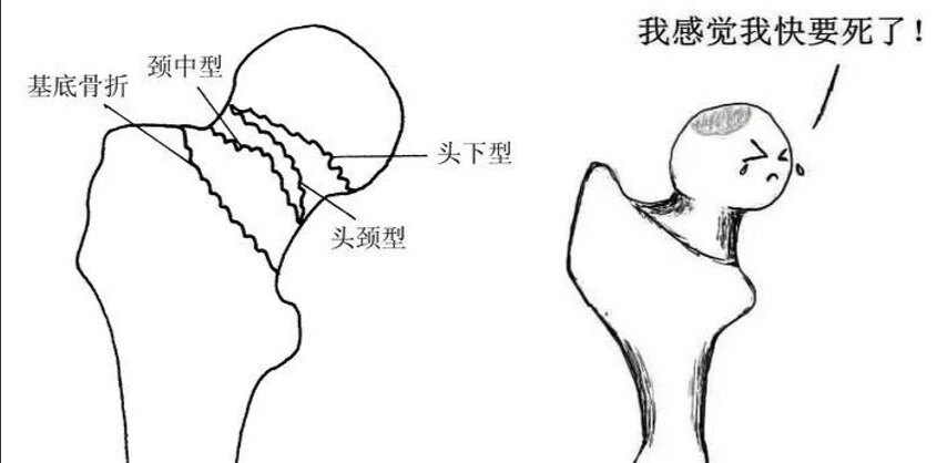 韦标方教授团队告诉你股骨颈骨折后股骨头咋还坏死了