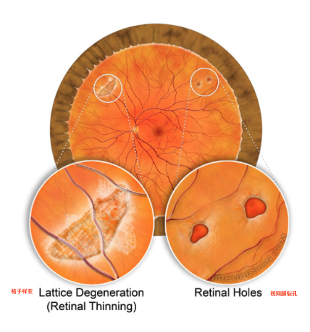 Lattice Degeneration | Vitrectomy for Floaters的副本.png