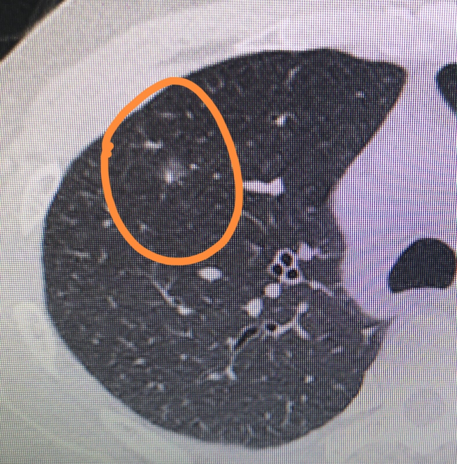 肺部结节 肺部结节