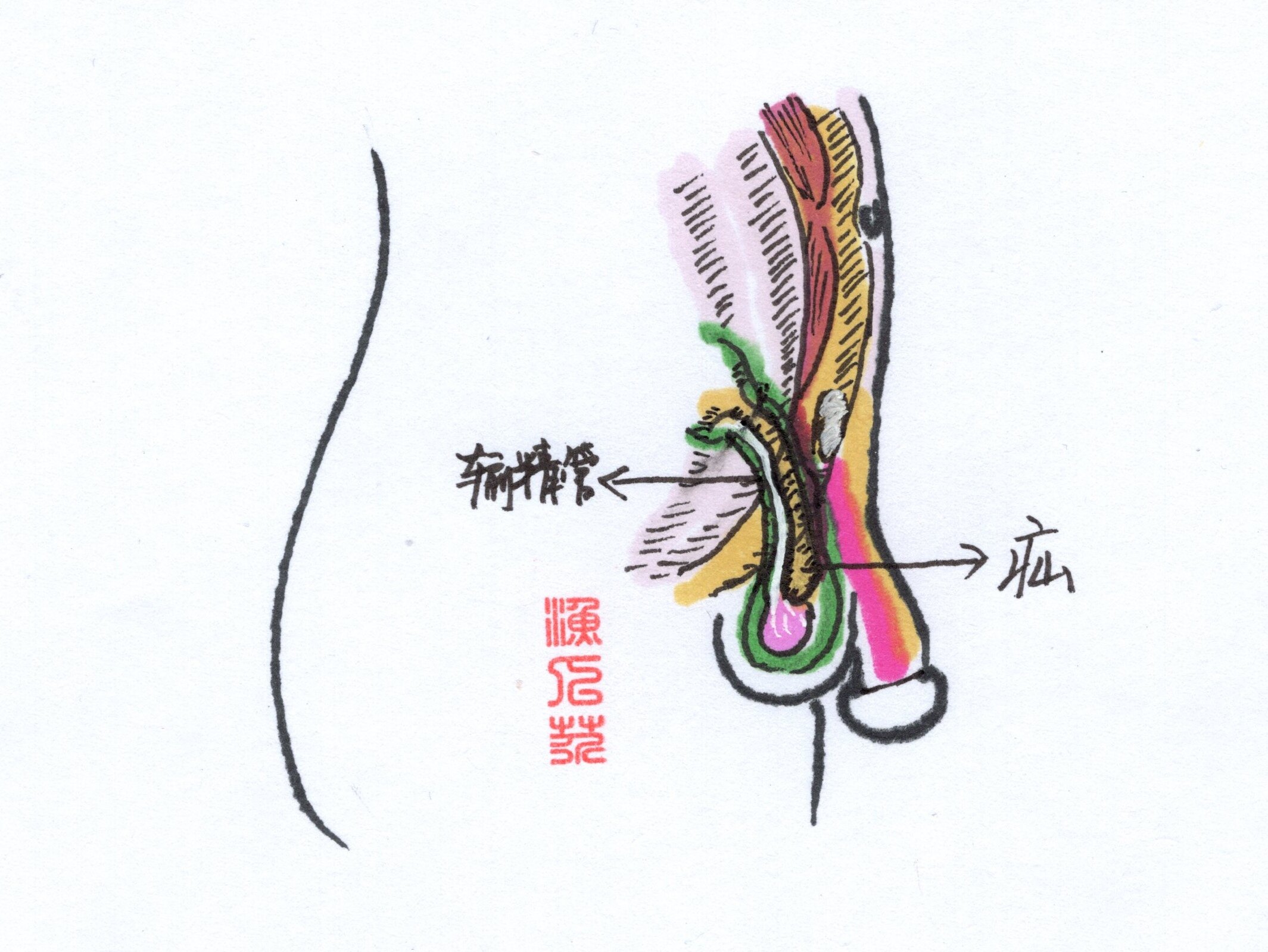 股疝手术步骤图解图片