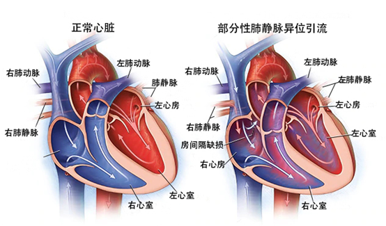 右肺静脉图片