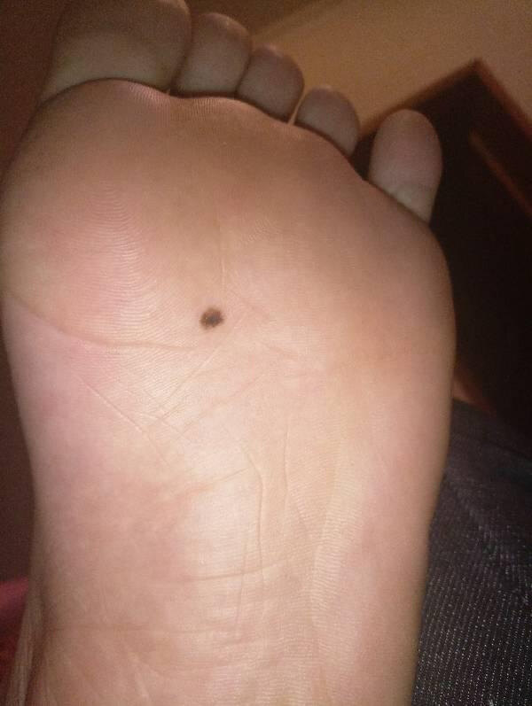 看这颗平平无奇的小痣是如何一步步演变成黑色素瘤的?