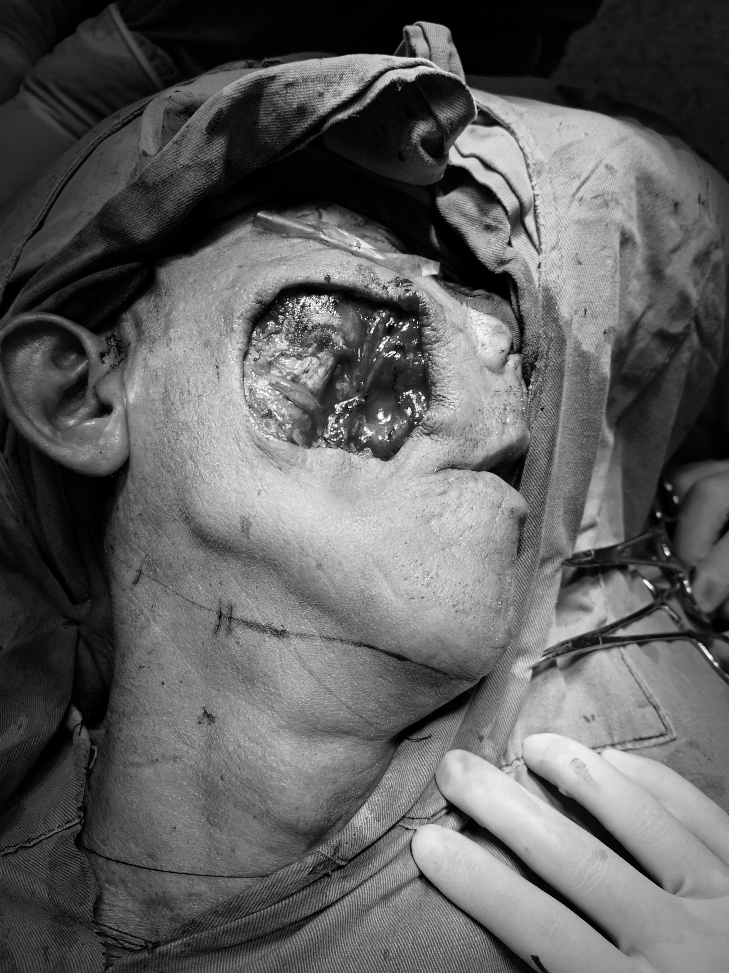 生长20余年面部巨大肿瘤被侧底切除并以颏下岛状皮瓣完美修复