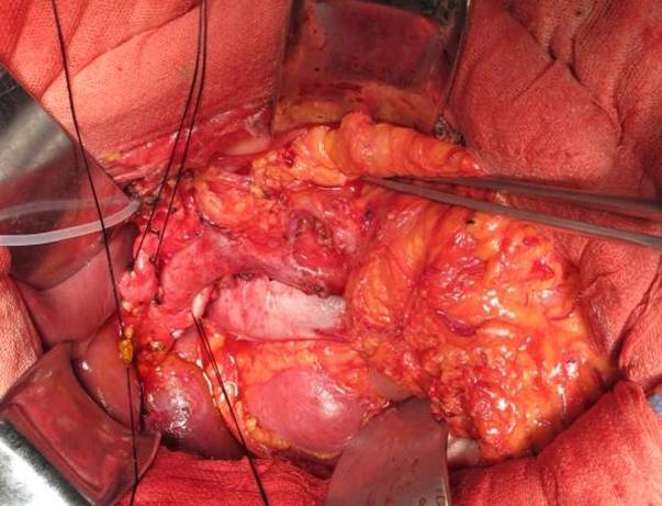 十二指肠巨大肿瘤成功切除病例 - 好大夫在线
