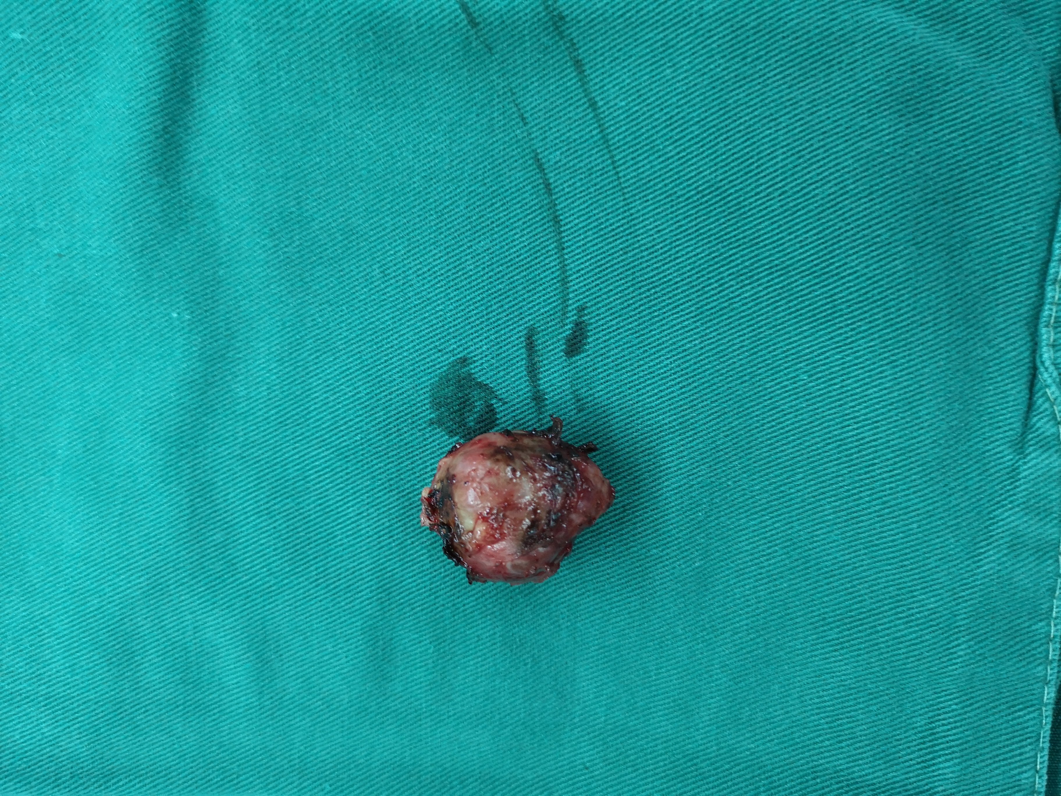 罕见病例:甲状腺癌咽旁淋巴结转移本中心第7例(15年8月起)