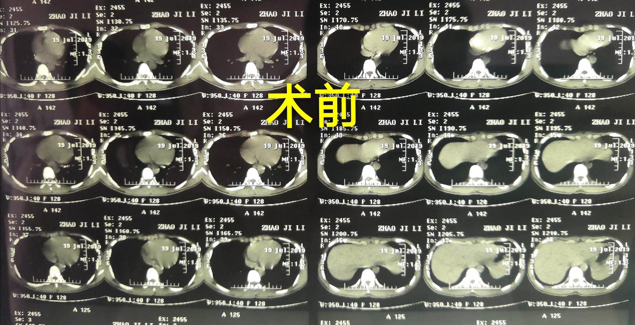 哈醫大二院胸外科經典病例之漏斗胸