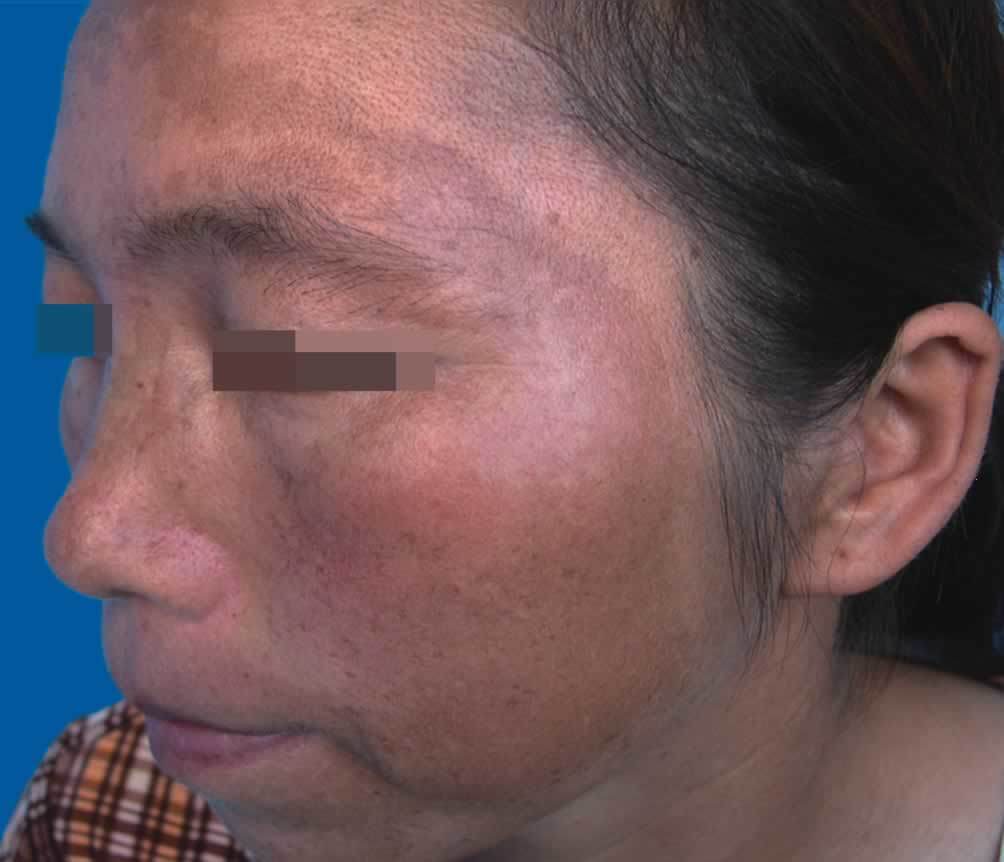 黄褐斑_黄褐斑发病原因 - 好大夫在线