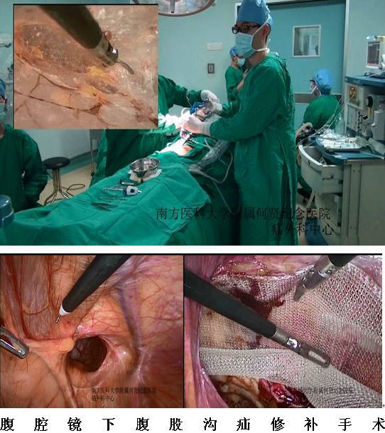 腹腔镜下疝修补术tapp图片