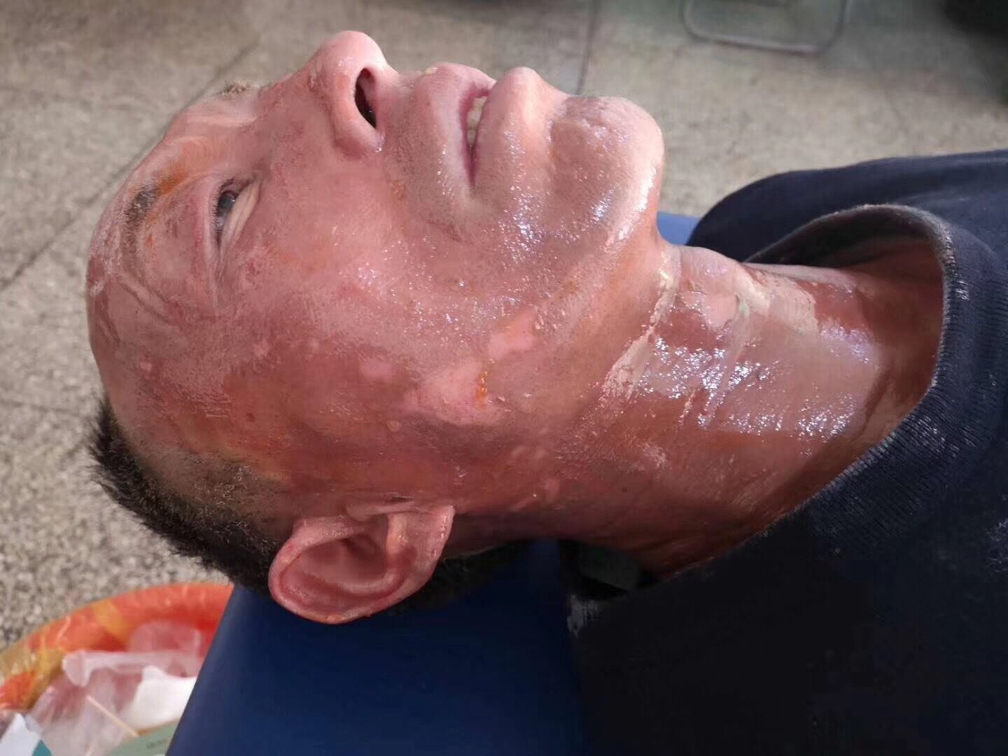 夏季需要注意哪些防止烧烫伤事故发生