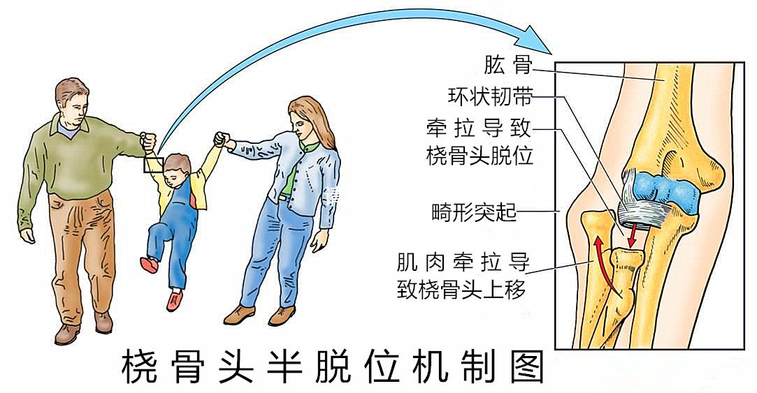 儿童桡骨头半脱位(摘勾)_桡骨头半脱位_病因_治疗方法 好大夫在线