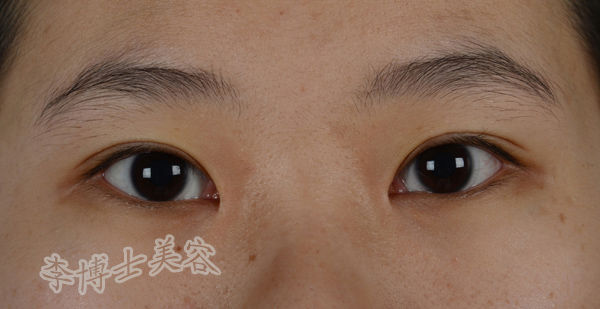 各种内眦赘皮的处理对策(即如何选择适当的开眼角方法)