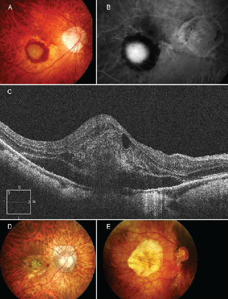 病理性近视cnv的定义及治疗的新进展总结