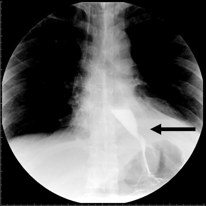 图3 术前x线造影提示巨大食管裂孔疝         术后消化道造影见