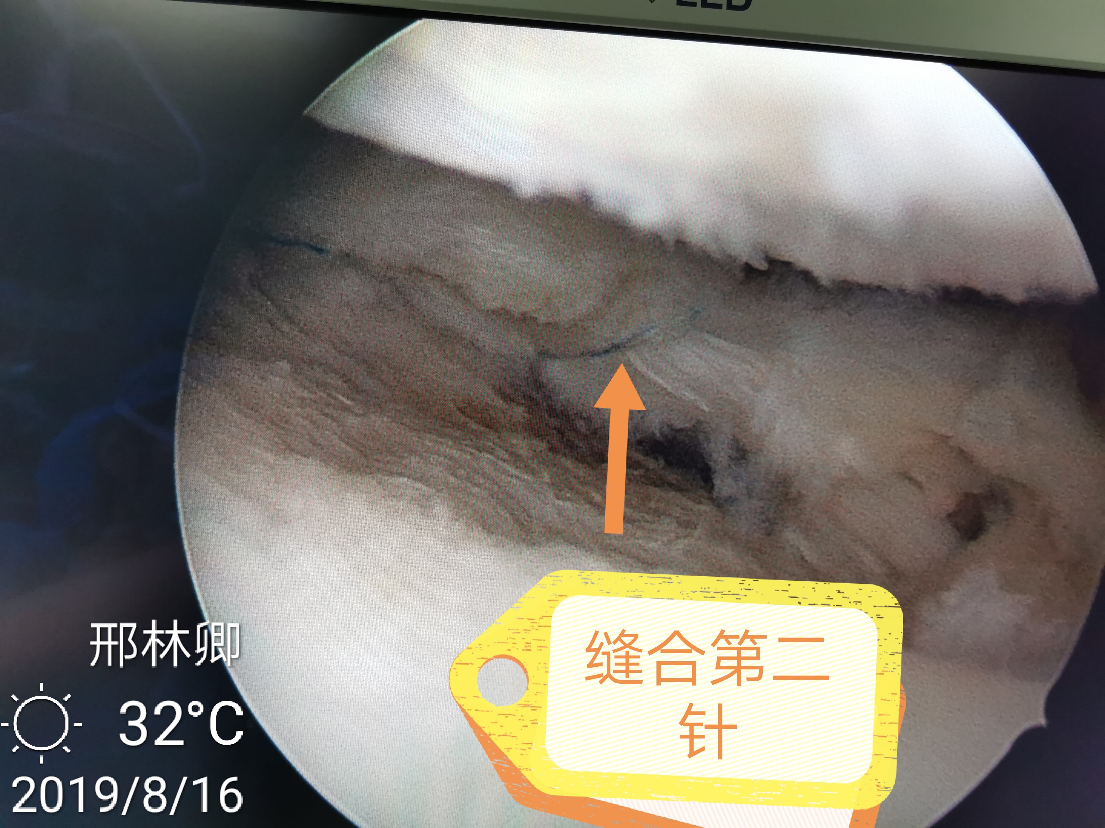 半月板缝合成功案例