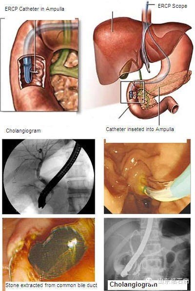 经内镜逆行胰胆管造影(ercp) - 好大夫在线