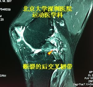 但是,能在核磁上清楚地显示后交叉韧带断口的情况很少.