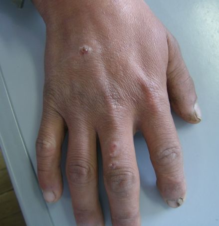 挤奶人结节 (原创)