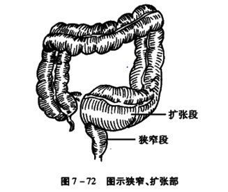 巨结肠分型图片