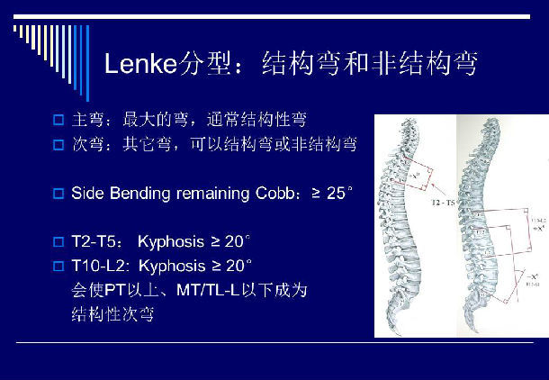 脊柱侧弯king分型和lenke分型