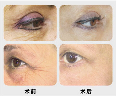 热点关注:鱼尾纹----小切口除皱术效果可维持多久?