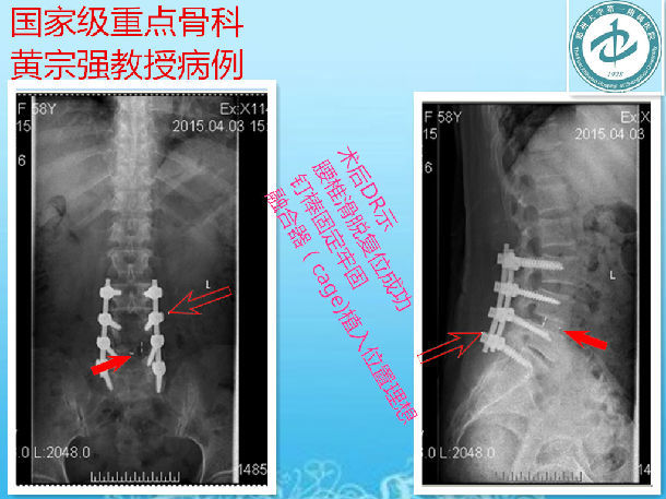 腰椎滑脫腰椎椎管狹窄症成功手術