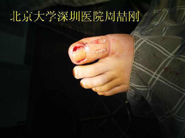 嵌甲甲沟炎——甲床成形术的手术过程及术后随访 - 好大夫在线