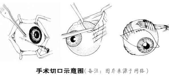 斜视手术图解图片