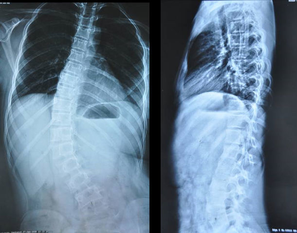 脊柱侧弯翻修 - 好大夫在线