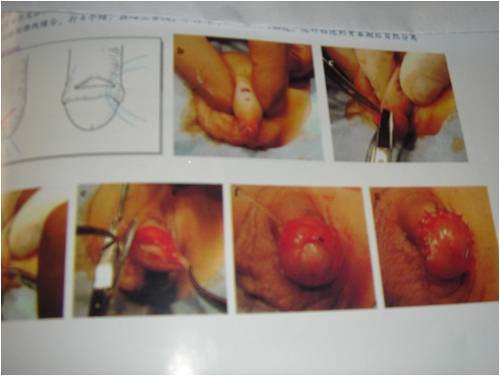 包茎扩张术 分离术图片