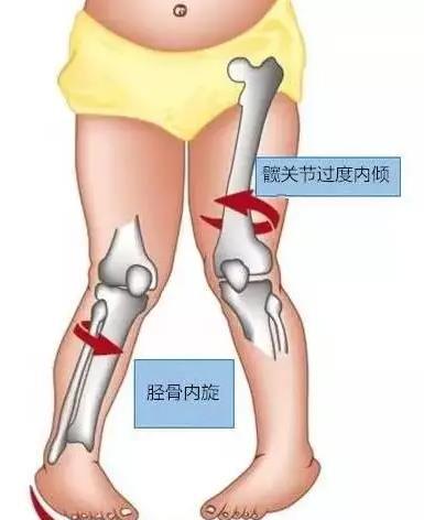 门诊最常见的内八字步(内八字足)可能继发于足部畸形,股骨或胫骨内旋