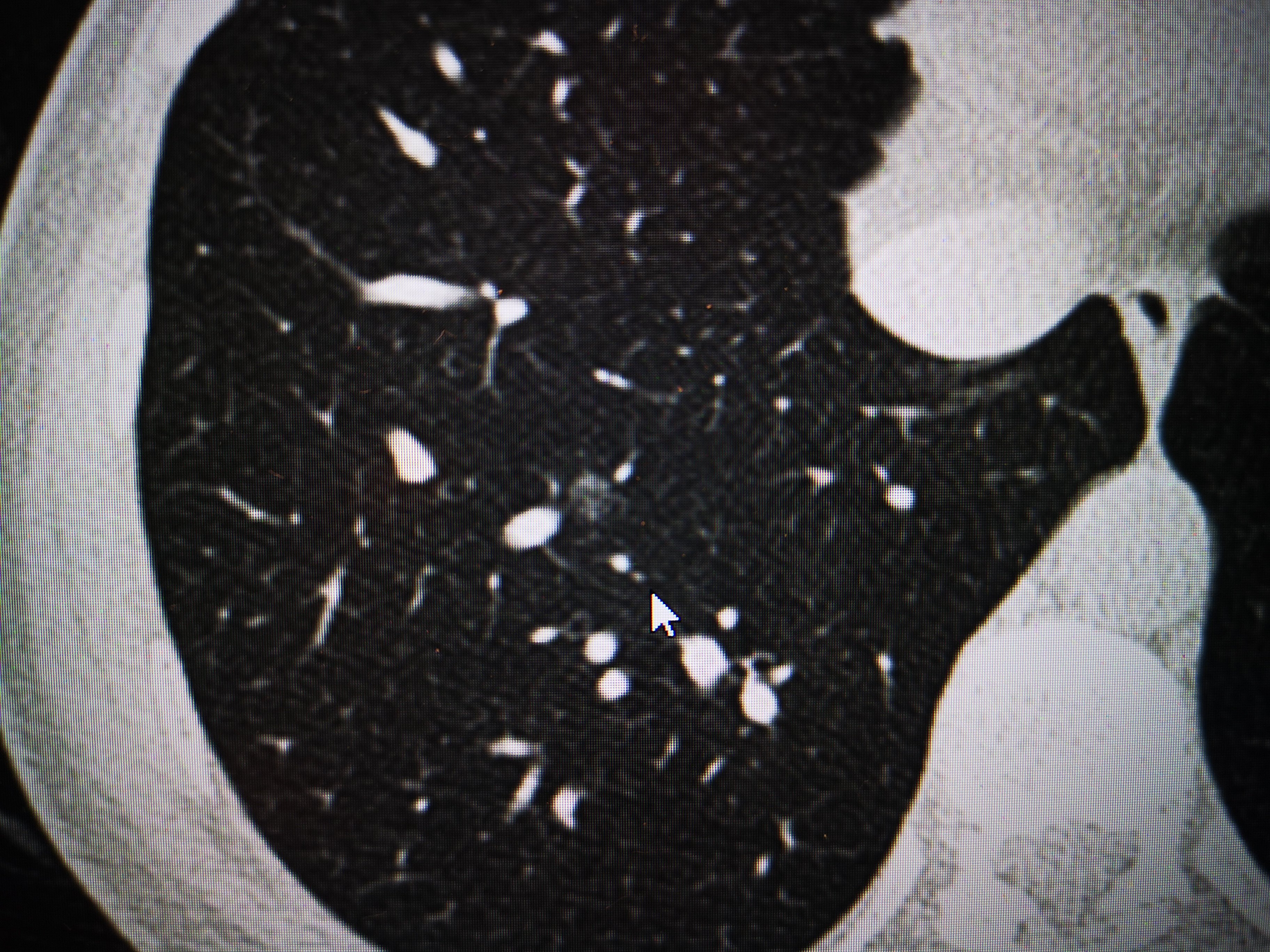 肺结节/磨玻璃结节经典病例集合,看了你也是专家!持续更新.谢谢关注!