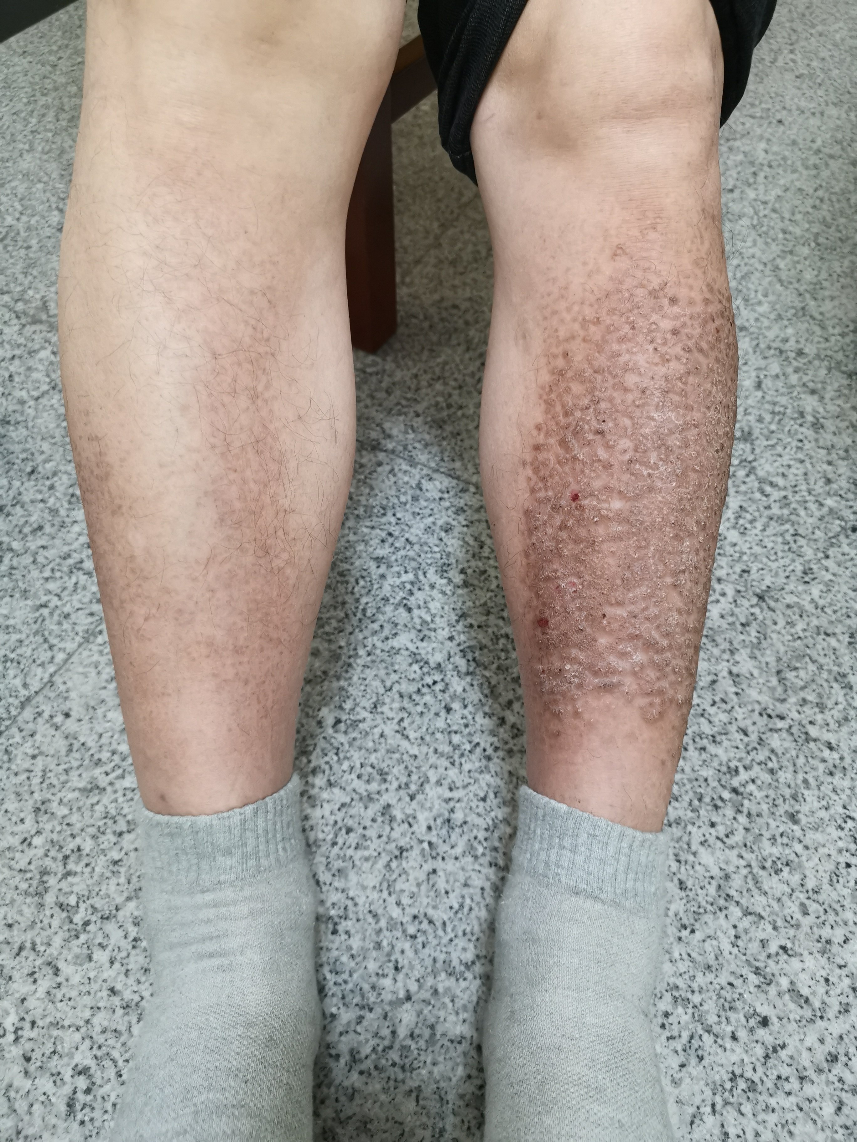 看图诊断:小腿密集丘疹的诊治