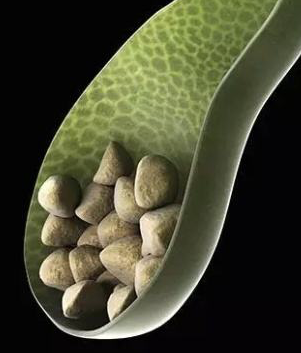 快速排出肾结石的小偏方_肾结石怎么能快速排出_排出肾能结石快速排出来吗