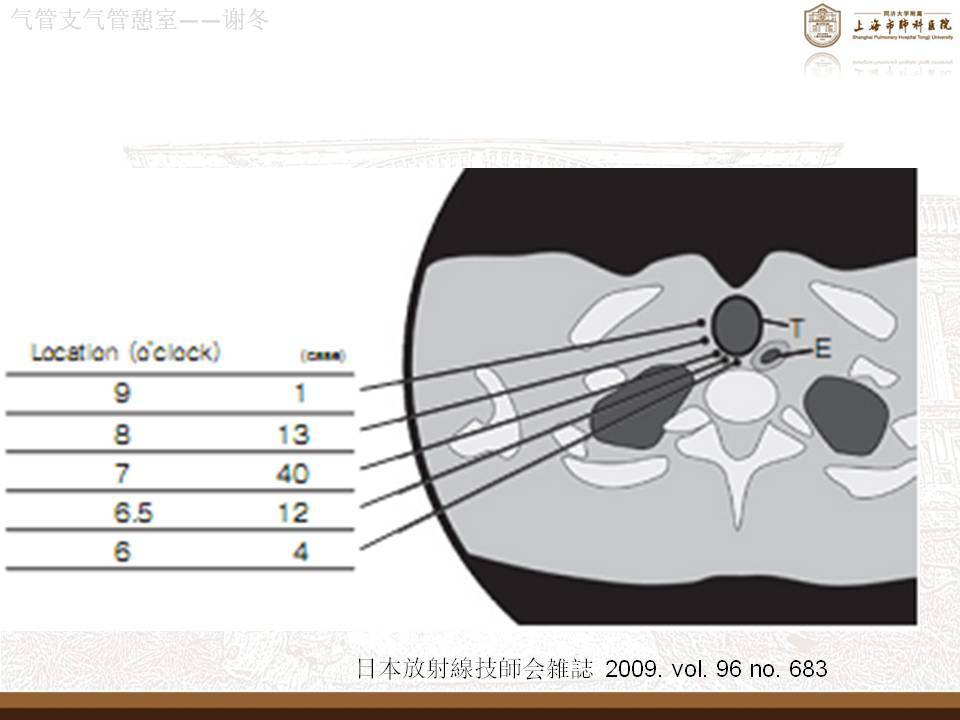 气管憩室是什么疾病?需不需要治疗?