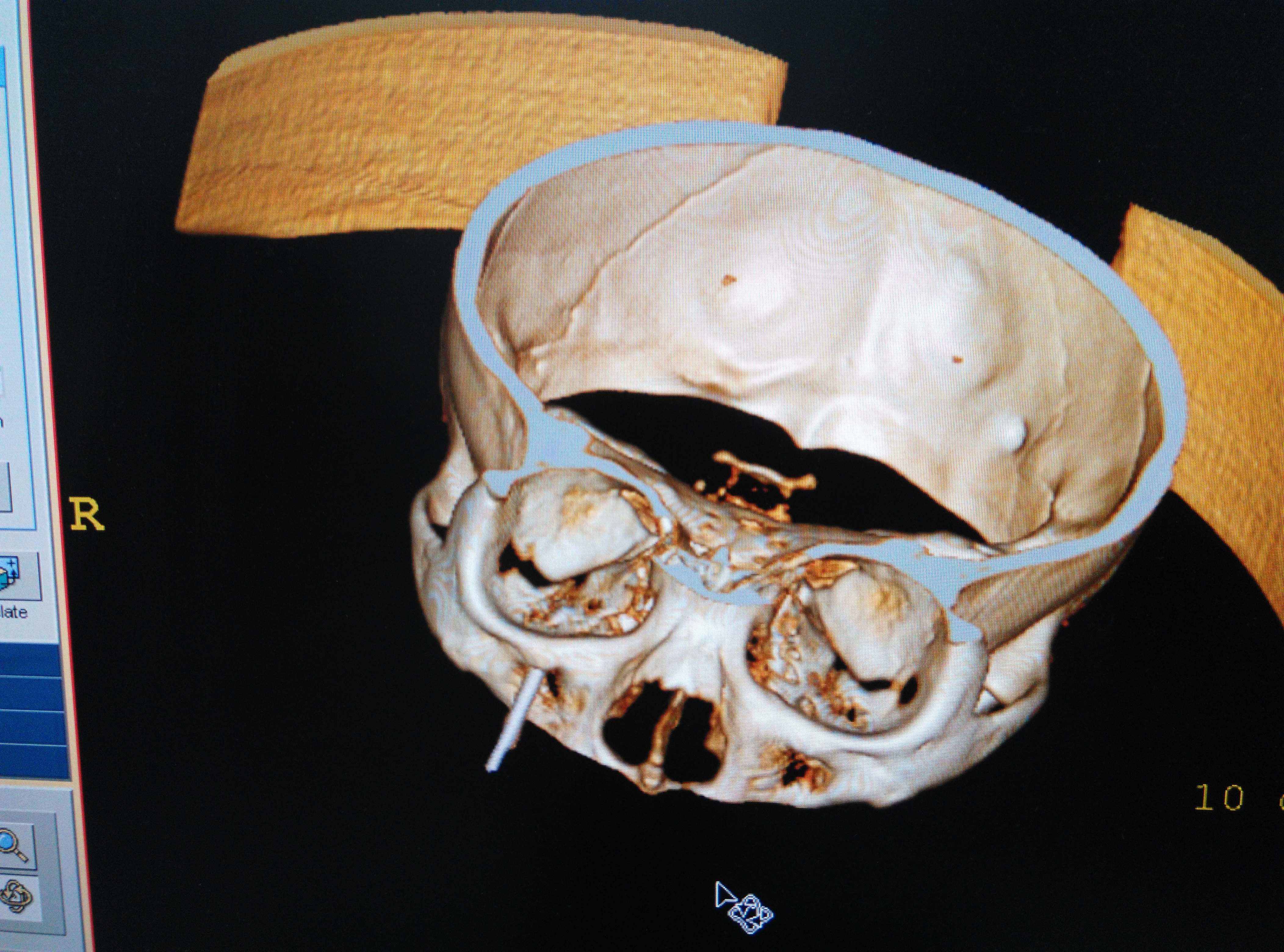 三叉神经痛周围神经毁损术
