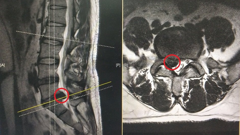 腰椎mri示:l5-s1椎間盤脫出並下游離,神經受壓迫嚴重(下圖中紅色圈