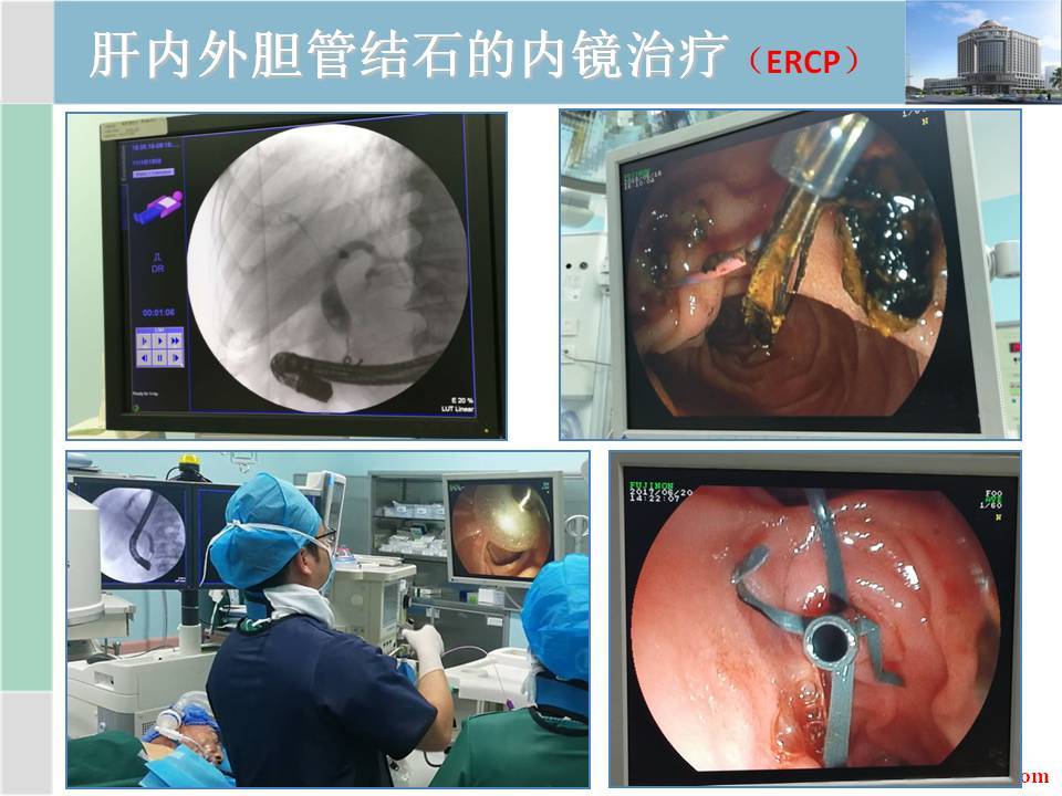 (4) 膽道鏡取石膽道鏡取石一般多用於膽道術後殘留結石,且膽道引流管