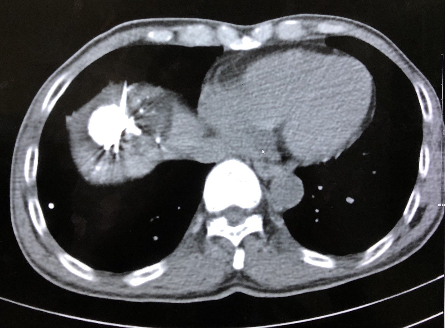 氩氦刀冷冻消融治疗膈顶肝癌案例分享 - 好大夫在线