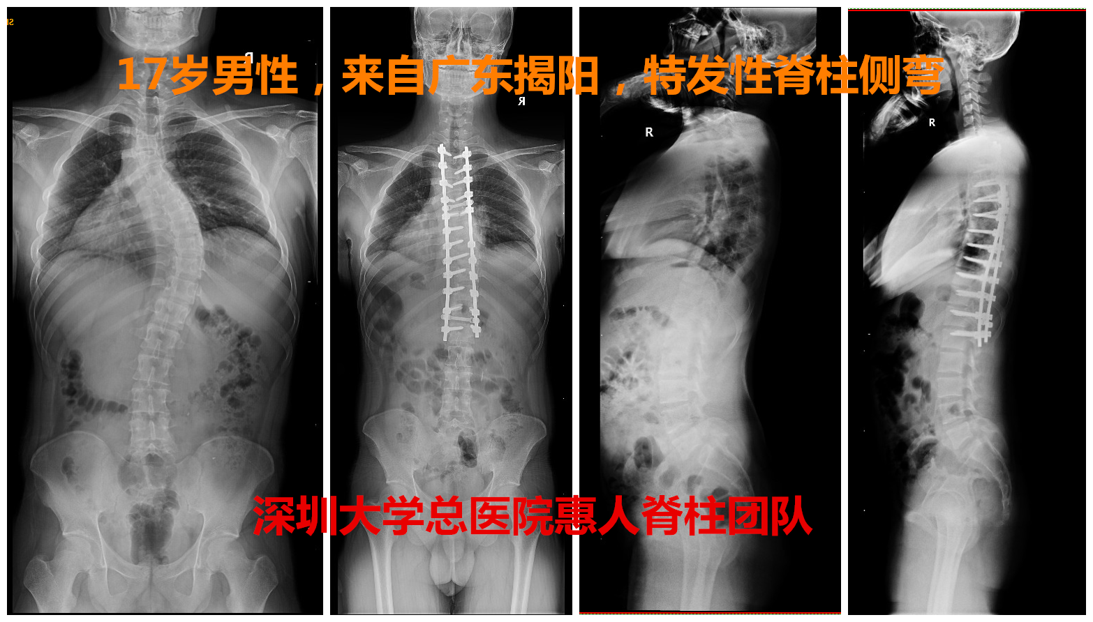 特发性脊柱侧弯的手术治疗——陶惠人教授手术案例 - 好大夫在线