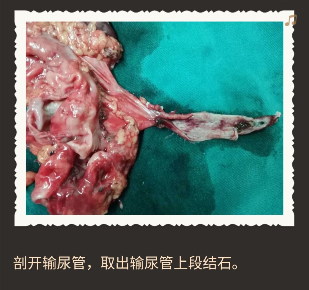 右输尿管下段结石图片图片