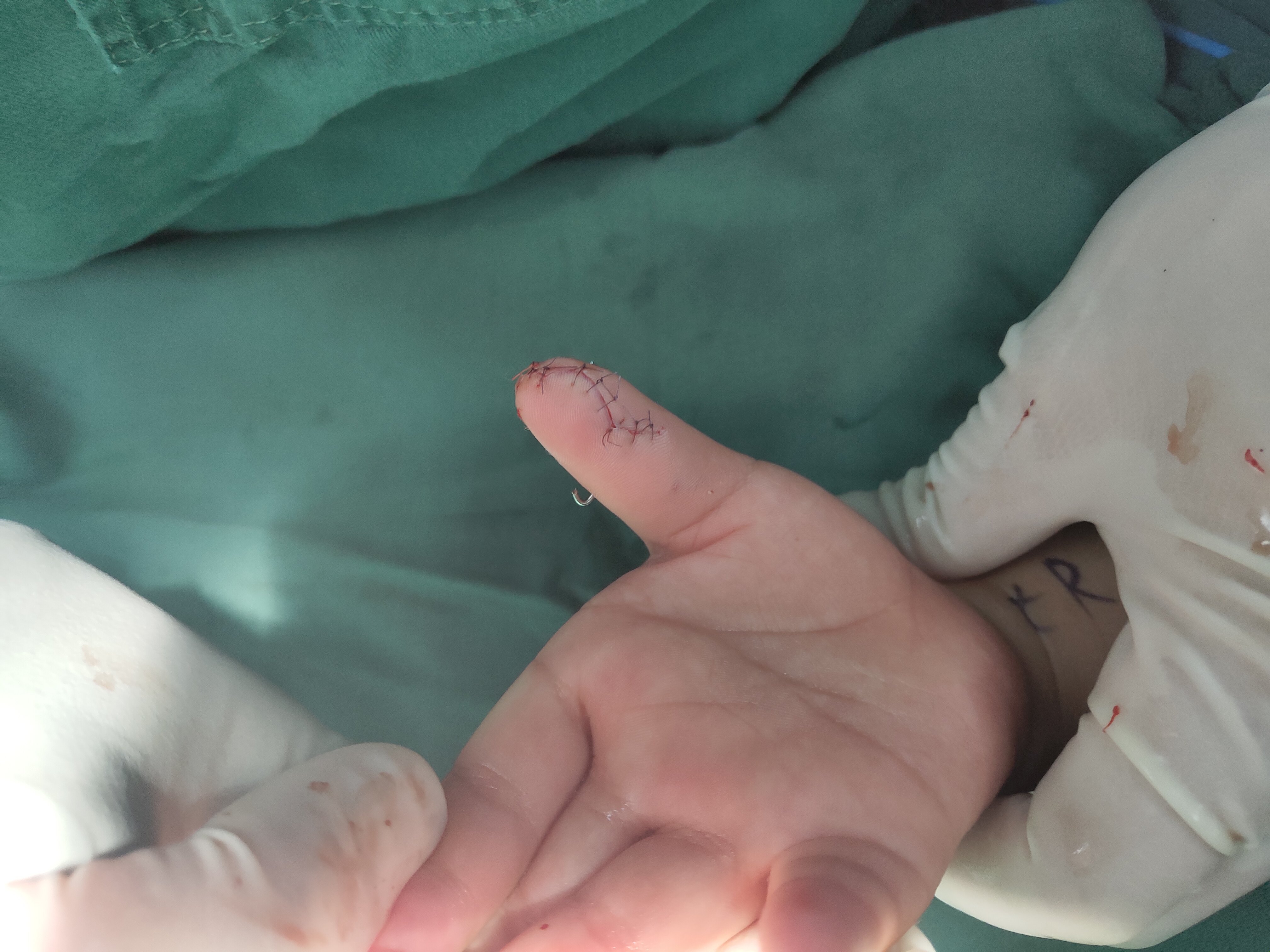 儿童复拇指畸形 - 好大夫在线